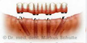 All-On-Four-Methode - Neigung der hinteren Implantate