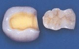 inlay