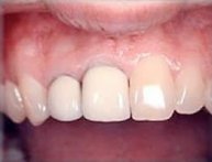 all-porcelain
crowns