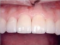 all-porcelain
crowns