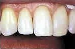 composite fillings