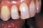 composite fillings