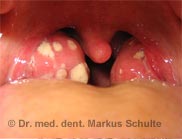 Tonsilitis - Mandelentzündung
