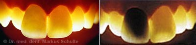 Lichtdurchlässigkeit von Vollkeramikkronen im Vergleich mit VMK-Kronen