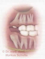 Geschwollen weisheitszahn Weisheitszähne